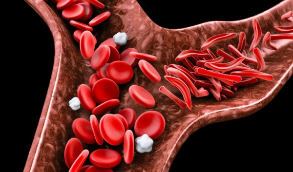 SUS vai disponibilizar dois novos medicamentos para a doença falciforme